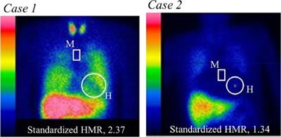 Decreased cholinesterase level combined with renal dysfunction and sympathetic denervation associated with increased cardiac mortality in systolic heart failure